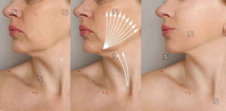 Threadlift adalah prosedur kecantikan non-bedah yang semakin populer untuk mengatasi penuaan kulit.